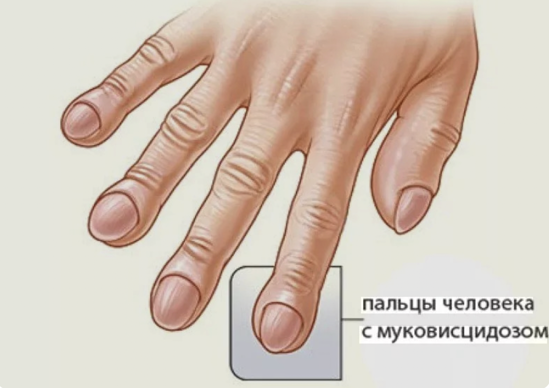 Муковисцидоз: что это, симптомы и лечение